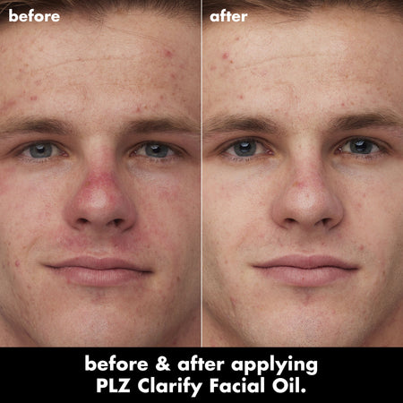 E.L.F. PLZ Clarify Huile Visage Acide Salicylique 2% Points Noirs